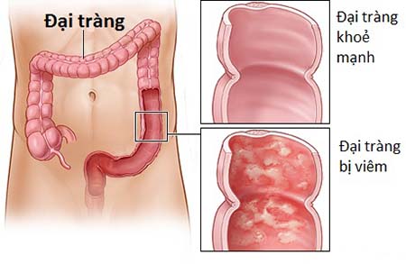 viêm đại tràng là gì