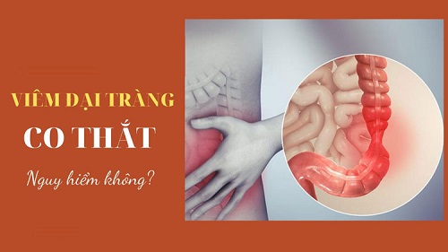 triệu chứng viêm đại tràng co thắt