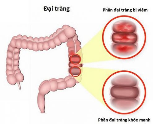 viêm đại tràng có nguy hiểm không