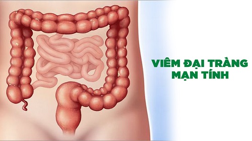 bệnh viêm đại tràng có chữa khỏi được không