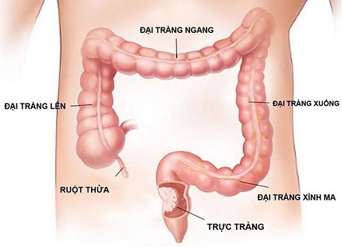 ưng thư đại tràng sigma