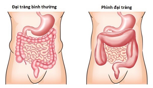 phình đại tràng