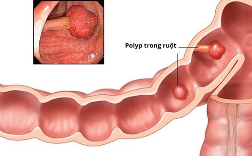 poly đại tràng