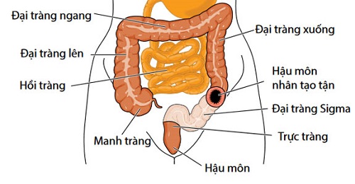 ung thư đại tràng