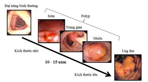 tiến triển của ung thư đại tràng