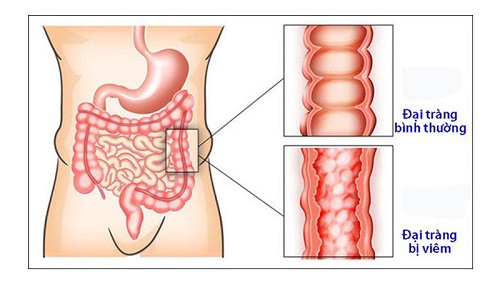 đại tràng co thắt và viêm đại tràng