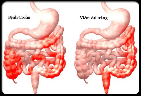 các bệnh về đường tiêu hóa