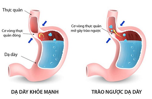 các bệnh về đường tiêu hóa