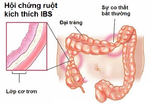 hội chứng ruột kích thích