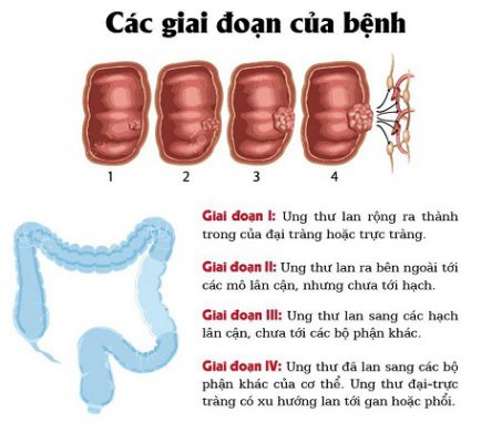 Ung thư đại tràng giai đoạn 2