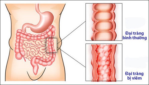 viêm đại tràng co thắt là gì